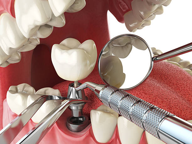 Best Emergency Dental Services for Seniors in Santa Maria, CA